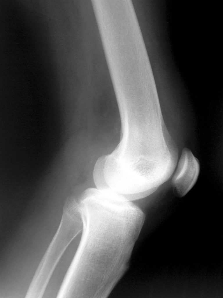 Experts say the pain associated with arthritis can lead to mental health issues.